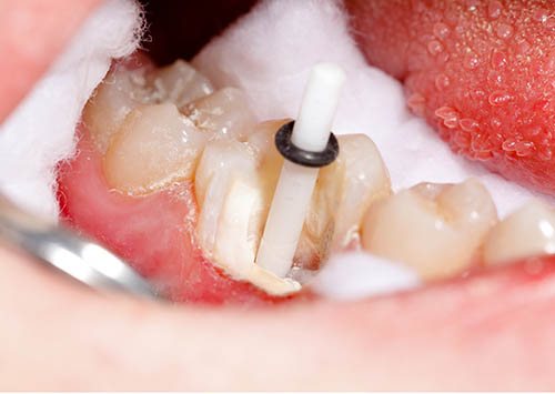 The aesthetic restoration of a lower molar tooth with composite resin, strengthened with fiber glass post.